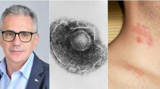 Aumentano i casi Fuoco di Sant’Antonio, Pregliasco: "Fate attenzione agli occhi se.. Altro...