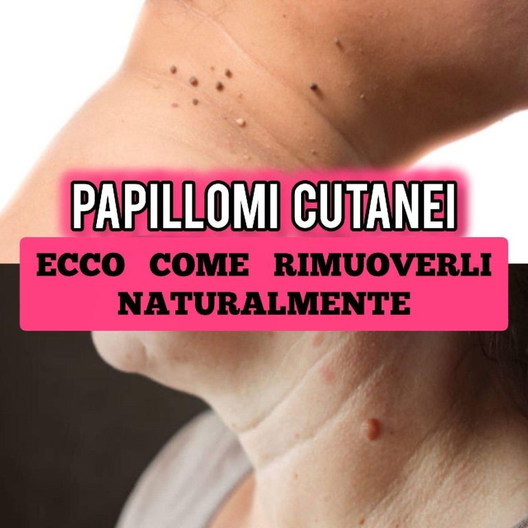 Papillomi cutanei: ecco 4 modi per eliminarli: basta semplicemente ma...Altro...