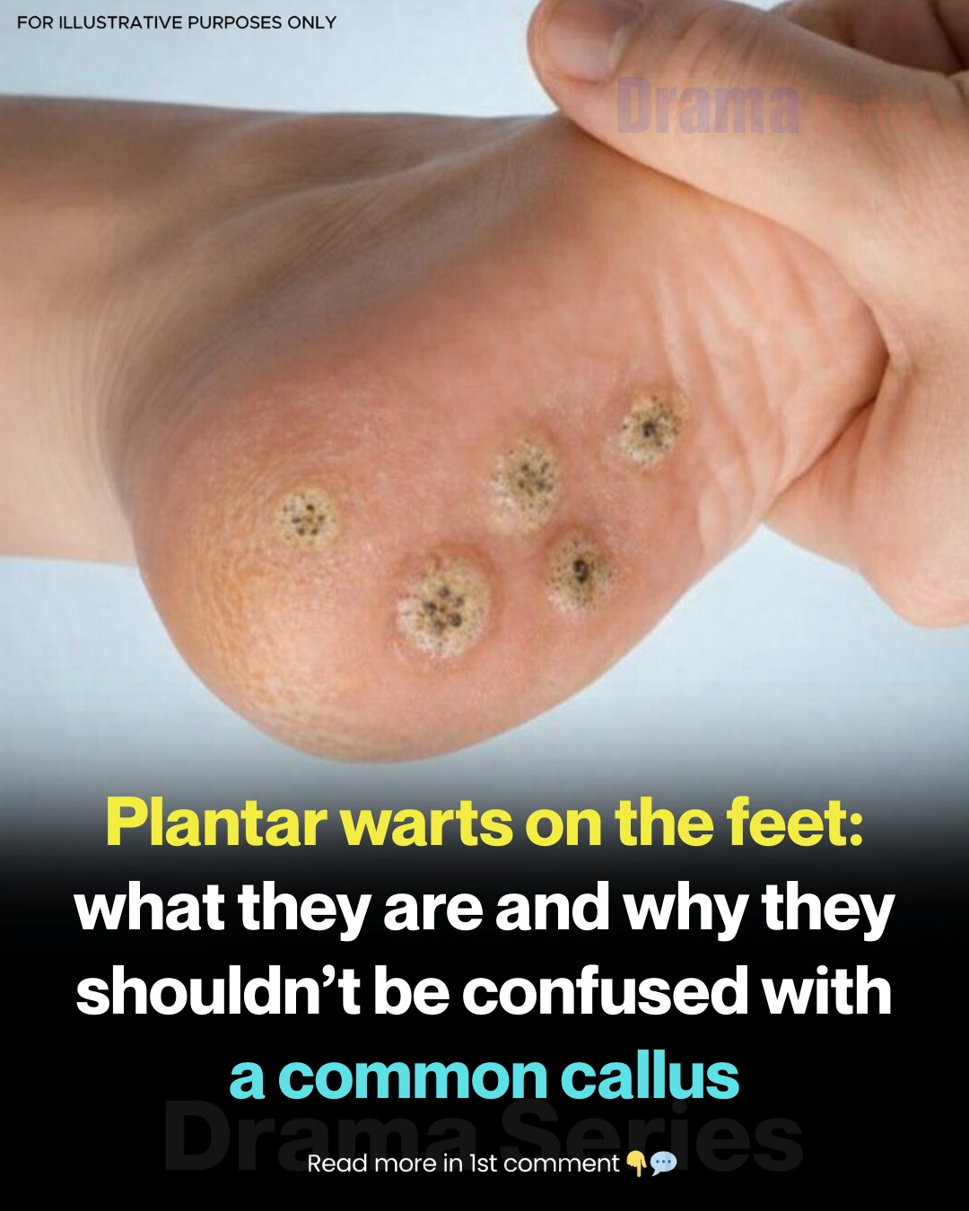 Understanding the Difference Between Calluses and Plantar Warts