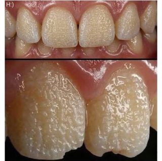Be Careful! This Is What Can Happen to Your Teeth When You Eat Certain Everyday Foods and Drinks That Slowly Damage Enamel, Cause Staining, Increase Sensitivity, and Lead to Long-Term Dental Problems You Might Not Notice Until It’s Too Late to Reverse the Effects