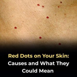 Small Red Dots On Your Skin: What They Could Mean And When To Act — From Harmless Causes Like Cherry Angiomas, Irritation, Or Heat Rash To Allergic Reactions, These Spots Are Often Benign. However, Sudden Spreading, Unusual Changes, Or Accompanying Symptoms May Signal Infection Or Bleeding Issues, Making Prompt Medical Evaluation Important
