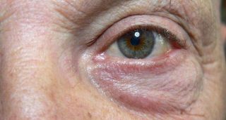 Miodesopsie: cosa sono i corpi mobili che vedi fluttuare negli occhi