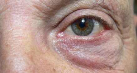 Miodesopsie: cosa sono i corpi mobili che vedi fluttuare negli occhi